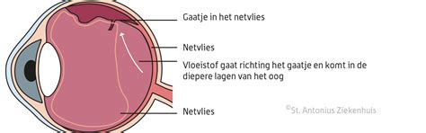 kenmerken netvliesloslating